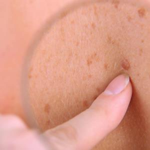 Nivolumab-relatlimab safer than ipilimumab-nivolumab in advanced cutaneous melanoma
