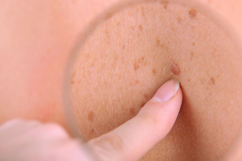 Nivolumab-relatlimab safer than ipilimumab-nivolumab in advanced cutaneous melanoma