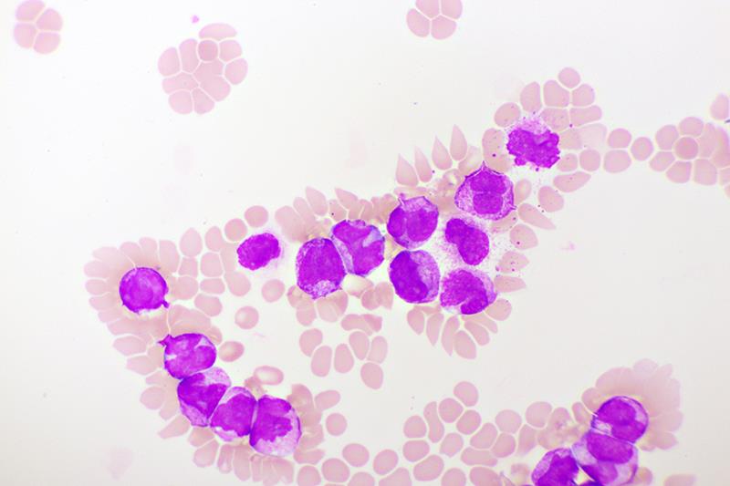 Chemo-free regimen a potential new standard of care in paediatric APL
