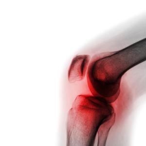 Topicals are first in the new treatment order for knee osteoarthritis
