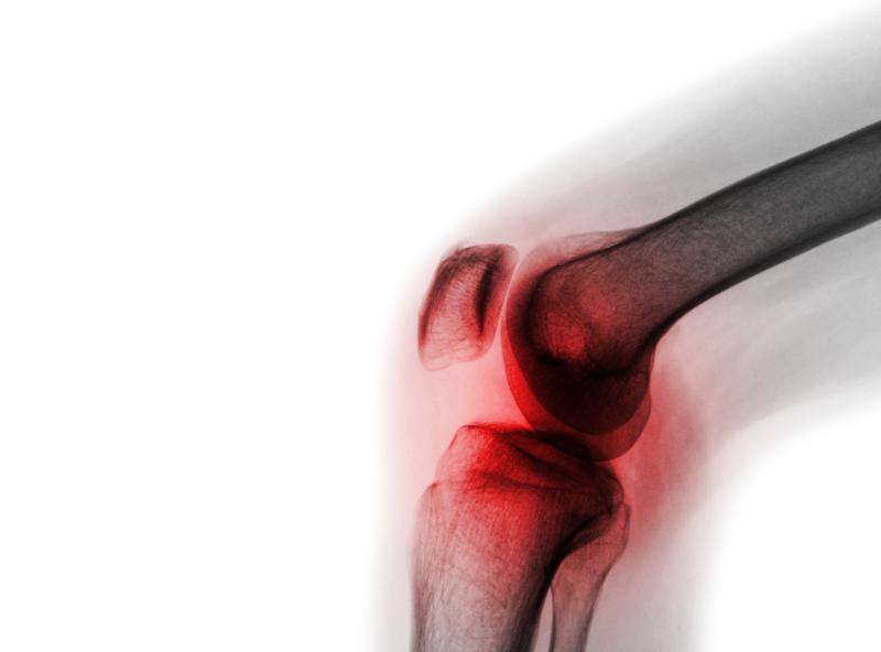 Topical first, opioids never: Navigating the new pharmacological hierarchy in knee osteoarthritis