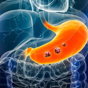 Paradoxical change in microbiome structure tied to gastric cancer, atrophy