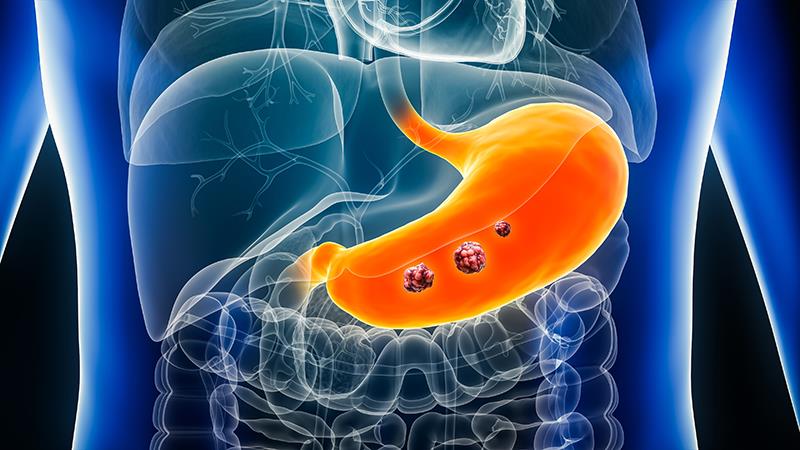 Paradoxical change in microbiome structure tied to gastric cancer, atrophy