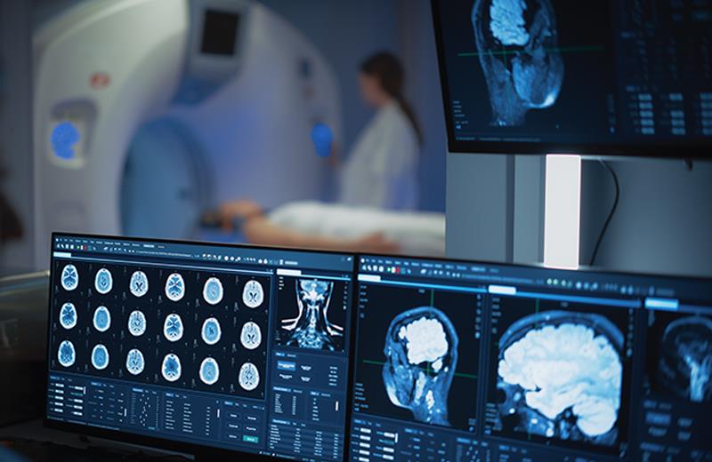 Early-onset RIL in glioblastoma patients treated with STUPP warrants monitoring