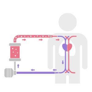 MVCD for VA-ECMO decannulation yields high success, low complication rates