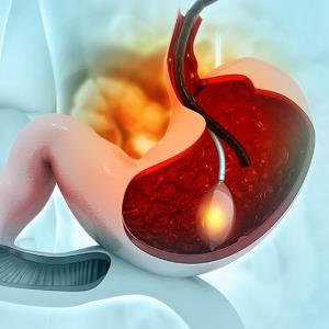 Clipping before ECI lowers risk of ectopic embolisms in gastric varices