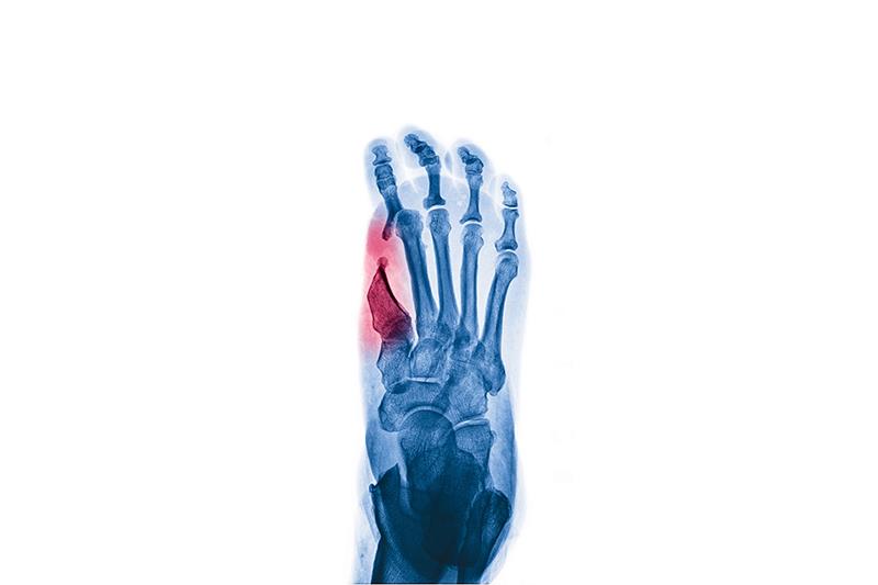 HBOT is beneficial for diabetic foot ulcers.