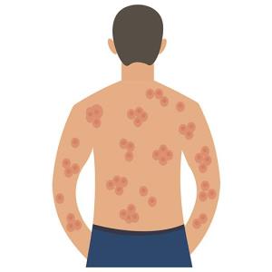 Lutikizumab shows promise in refractory hidradenitis suppurativa