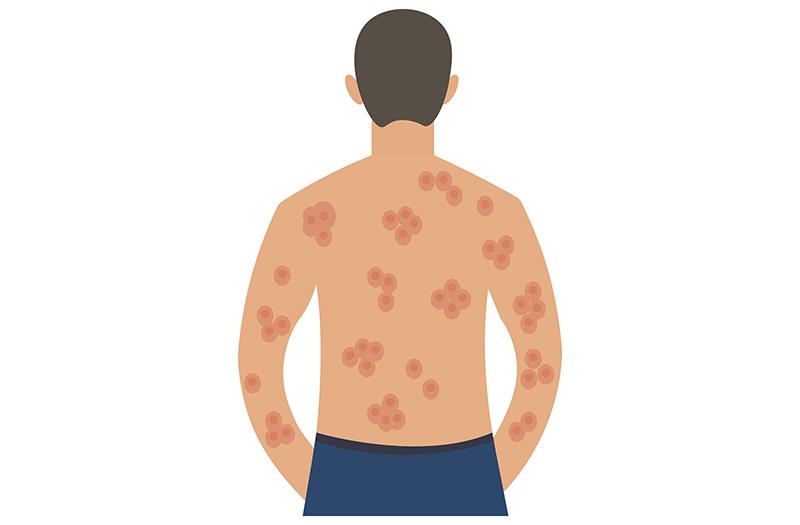 Lutikizumab shows promise in refractory hidradenitis suppurativa