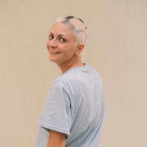 Switching between JAK inhibitors a feasible solution for severe alopecia areata
