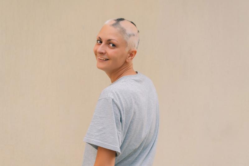 Switching between JAK inhibitors a feasible solution for severe alopecia areata