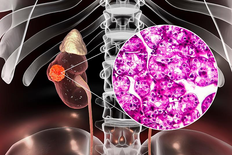 More complications, readmissions seen in RCC patients with comorbidities