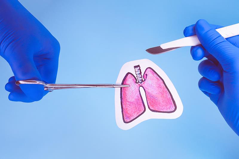 Lung transplant shows signal of benefit in select lung cancer patients