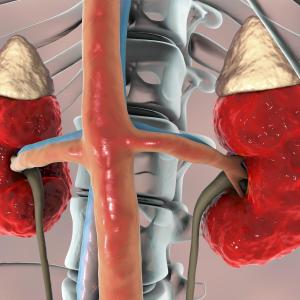 Low-dose rivaroxaban more harmful than beneficial in advanced CKD patients at high CV risk