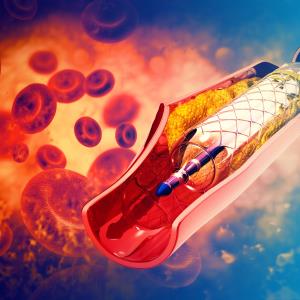 Abbreviated DAPT found safe in high-risk patients undergoing PCI