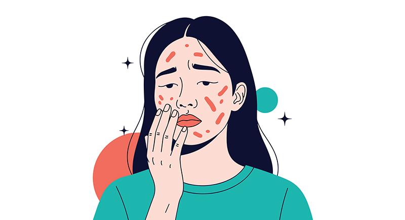 Topical ivermectin, encapsulated benzoyl peroxide come first among rosacea medications