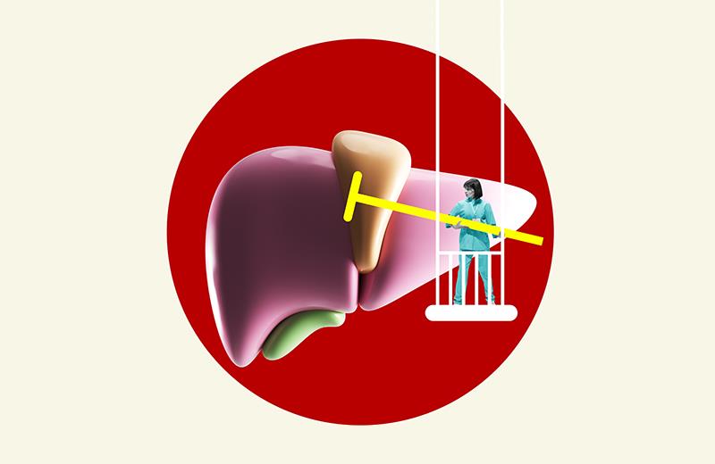 Bile acid reductions with odevixibat tied to improved LFTs in patients with PFIC2