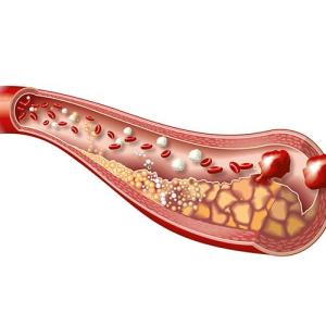 Novel lithotripsy device fares well in PINNACLE-I trial
