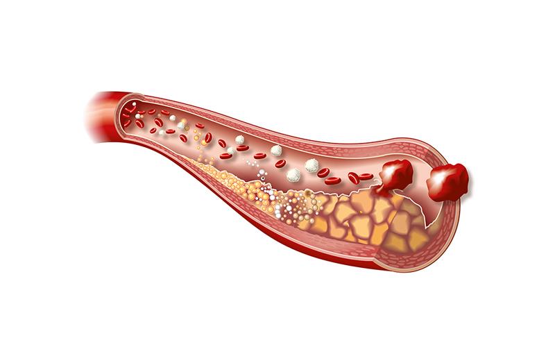 Novel device shows promise for the treatment of calcified coronary artery lesions.