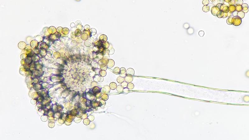 Sensitivity to A. fumigatus linked to severe bronchiectasis