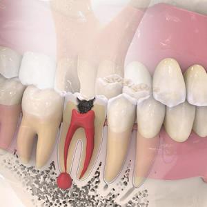 Pulpotomy fares better than selective dental caries removal