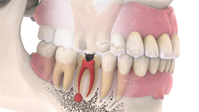 Full pulpotomy achieved higher success rates in avoiding root canal Tx or extraction than selective removal.