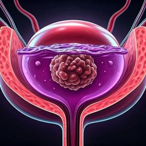 Toripalimab plus gemcitabine-cisplatin shows promise as neoadjuvant treatment in MIBC