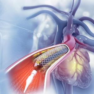 SCB holds slight edge over PCB for PAD in SIRONA trial