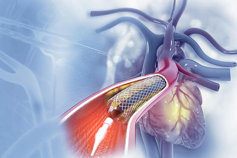 SCB holds slight edge over PCB for PAD in SIRONA trial
