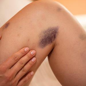 When easy bruising and fatigue suggest a blood disorder