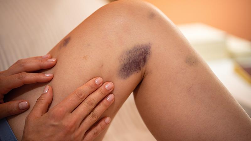 Non-cancerous blood disorders often involve problems with bleeding or abnormal clotting.