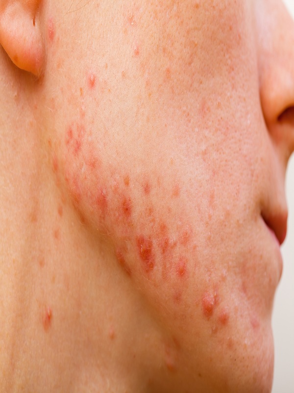 Mụn trứng cá