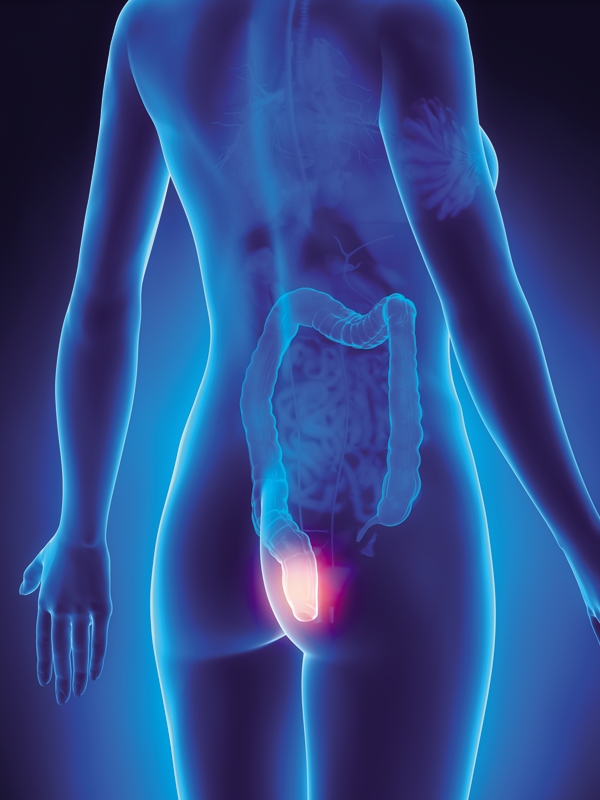 Hemorrhoids