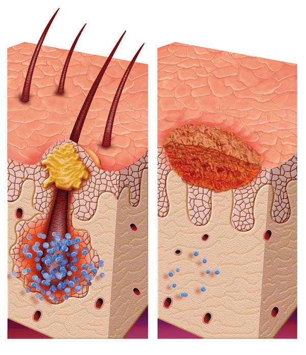 Pityriasis (Tinea) Versicolor (Pediatric)
