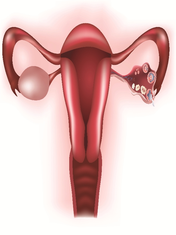 Polyendocrine Metabolic Ovarian Syndrome