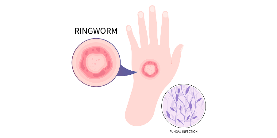 Tinea Corporis, Cruris and Pedis_Disease Background 1