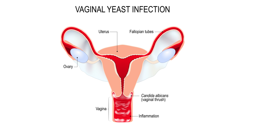 Vaginitis Trichomoniasis, Candidiasis, Bacterial Vaginosis_Disease Background 3