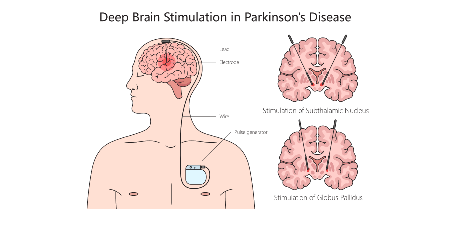 Parkinsons Disease and Dementia_Management 6