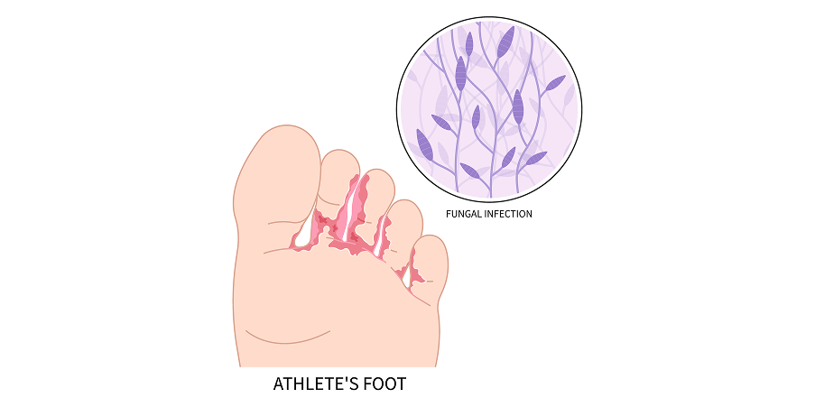 Tinea Corporis, Cruris and Pedis_Disease Background 2