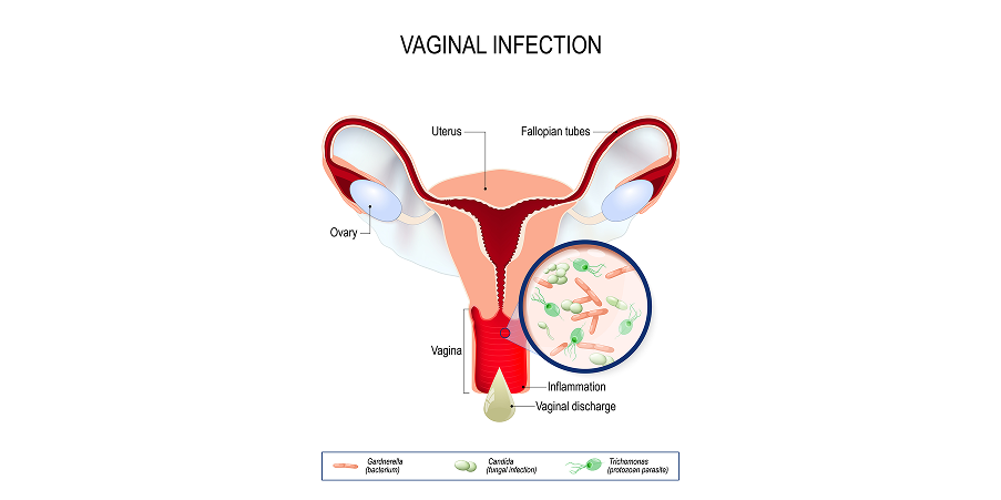 Vaginitis Trichomoniasis, Candidiasis, Bacterial Vaginosis_Disease Summary