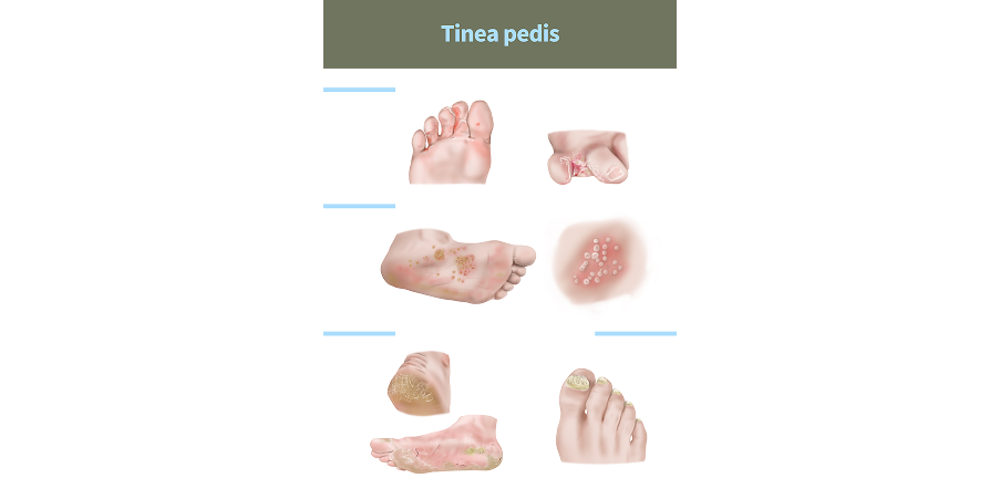 Tinea Corporis, Cruris and Pedis_Initial Assesment 3