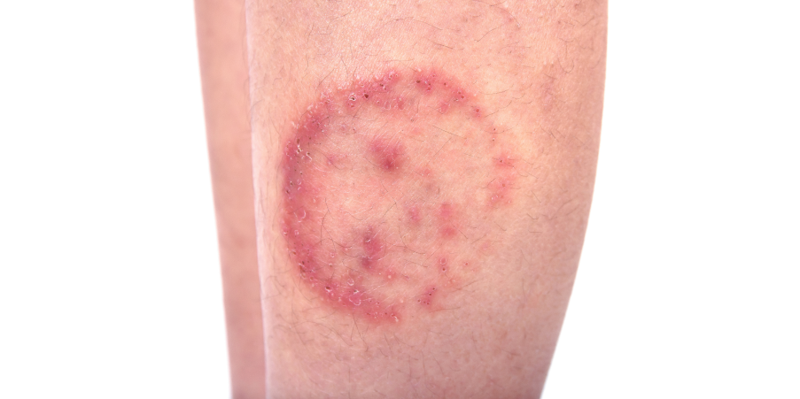 Tinea Corporis, Cruris and Pedis_Initial Assesment 1