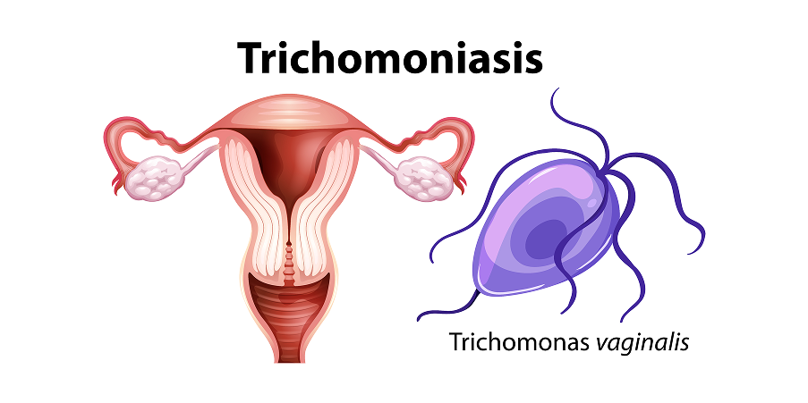 Vaginitis Trichomoniasis, Candidiasis, Bacterial Vaginosis_Disease Background 1