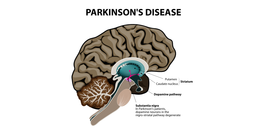 Parkinsons Disease and Dementia_Disease Background 2