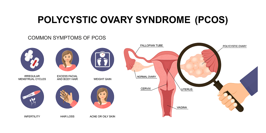 Polycystic Ovarian Syndrome_Initial Assesment 1