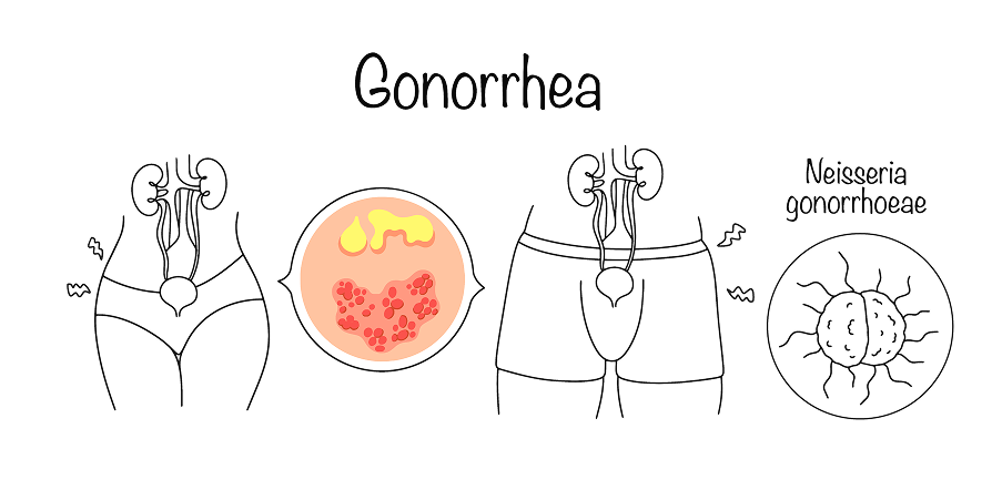 Gonorrhea - Uncomplicated Anogenital Infection_Disease Background 2