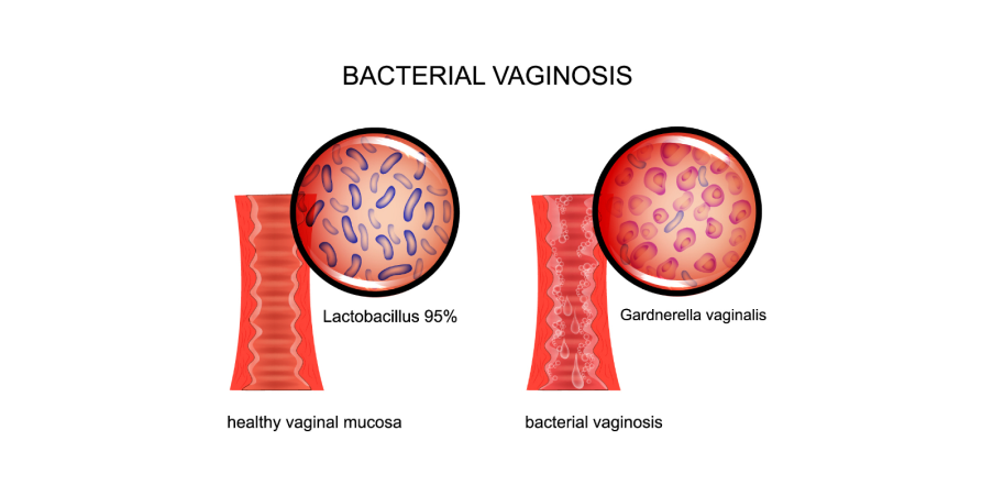Vaginitis Trichomoniasis, Candidiasis, Bacterial Vaginosis_Disease Background 2