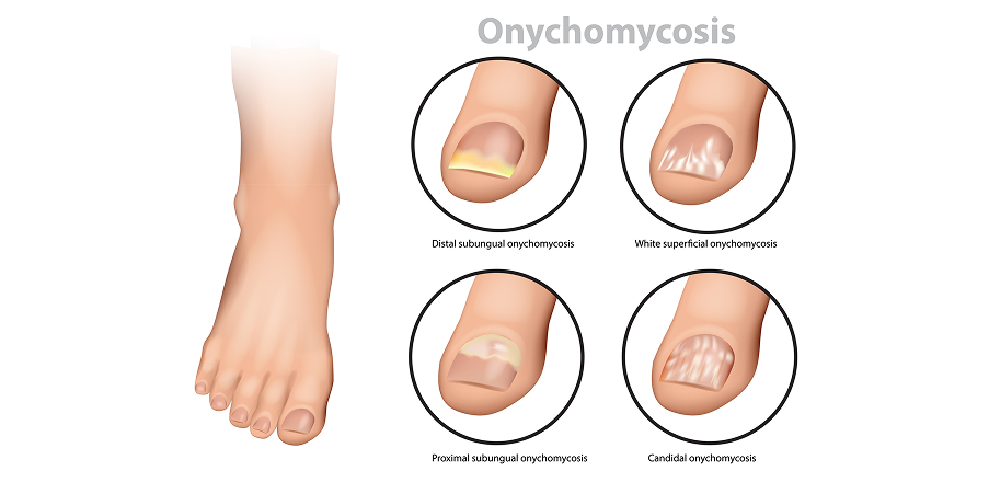 Tinea Unguium_Disease Background 3