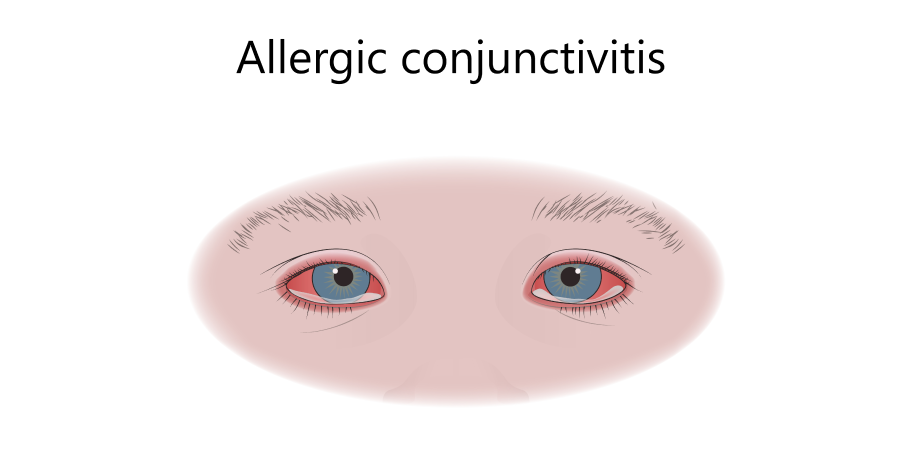 Conjunctivitis - Allergic, Seasonal and Perennial_Disease Background