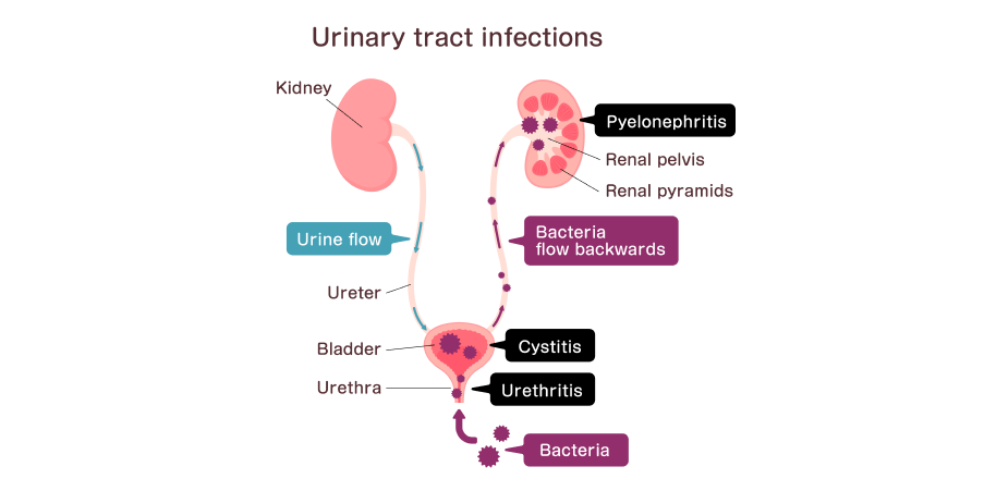 Urinary Tract Infection - Uncomplicated_Disease Background 2